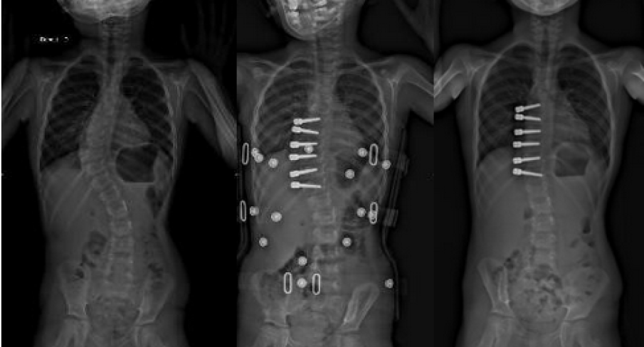 Chirurgie mini-invasive « vertebral body tethering » : le CHU Grenoble Alpes pionnier en France de cette technique