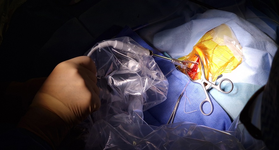 Une avancée chirurgicale inédite au CHU Grenoble Alpes : la pose d’un implant cochléaire avec le robot OTODRIVE