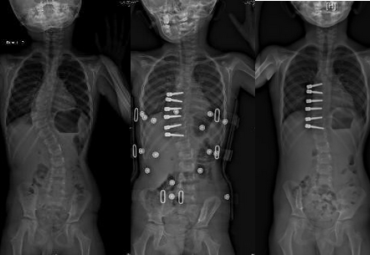 Chirurgie mini-invasive « vertebral body tethering » : le CHU Grenoble Alpes pionnier en France de cette technique